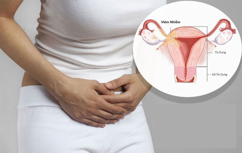 Dấu hiệu viêm phần phụ đặc trưng là đau vùng bụng dưới bất thường