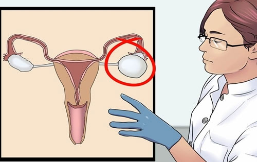 U nang buồng trứng kích thước đạt boa nhiêu thì mổ?