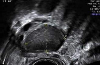 Liệu hình ảnh siêu âm lạc nội mạc tử cung có giúp chẩn đoán bệnh chính xác