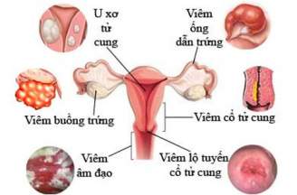 Nguyên nhân chính và triệu chứng gây bệnh u nang cổ tử cung