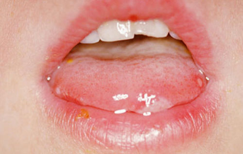 Bệnh lậu giai đoạn đầu ở miệng dễ bị nhầm lẫn với bệnh thông thường