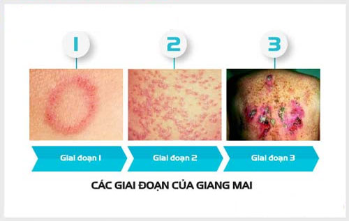 Khi thấy biểu hiện của giang mai nên đến các địa chỉ chuyên trị giang mai Tân Uyên - Dĩ An - Thuận An